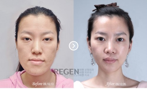 รวมภาพ Before & After สาว ๆ ที่ศัลยกรรม