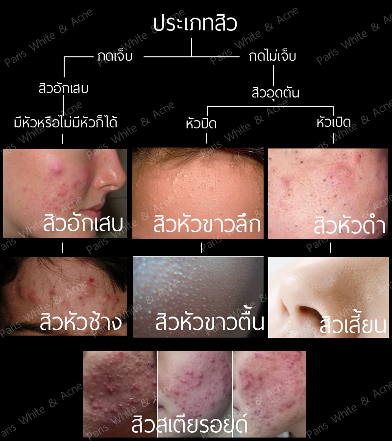 มาดูว่าคุณเป็นสิวอะไรกันบ้าง